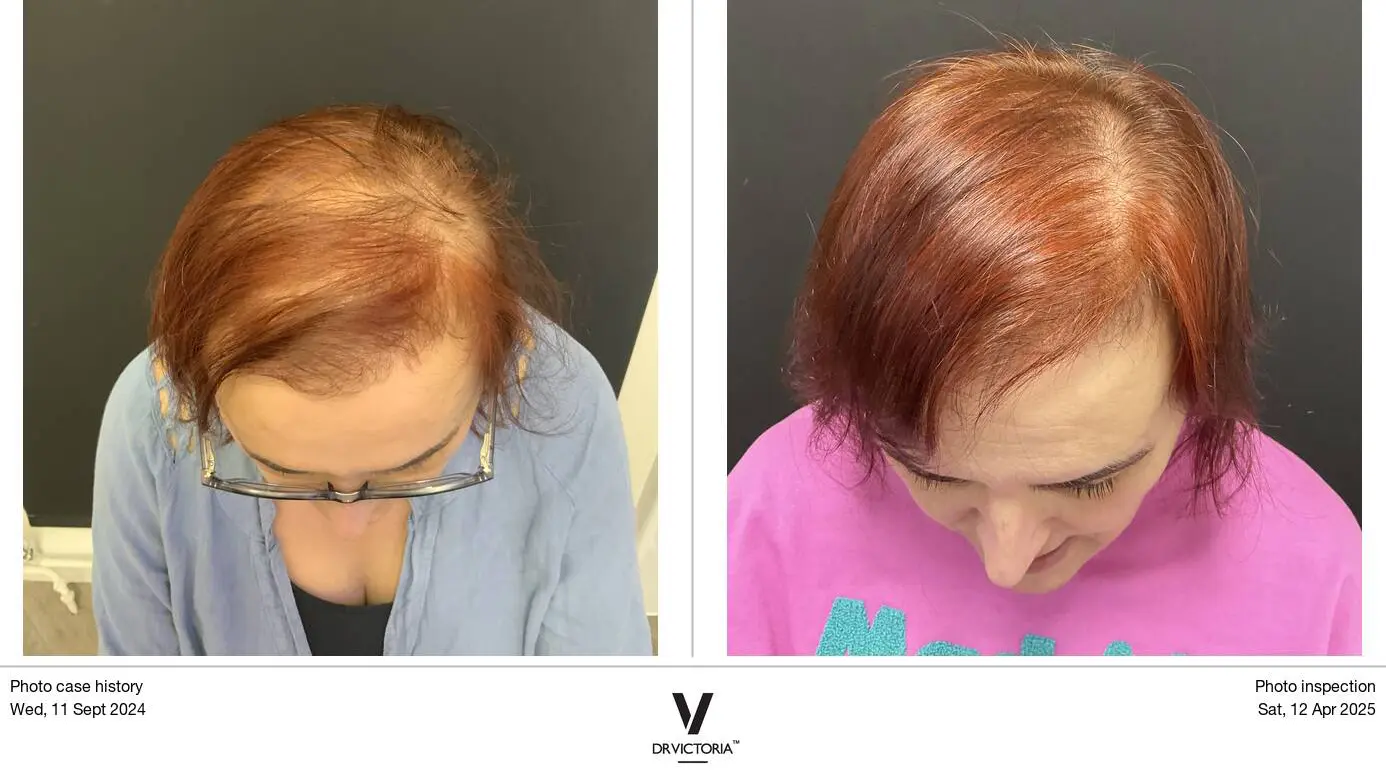 Before and after image of polynucleotide hair loss treatment