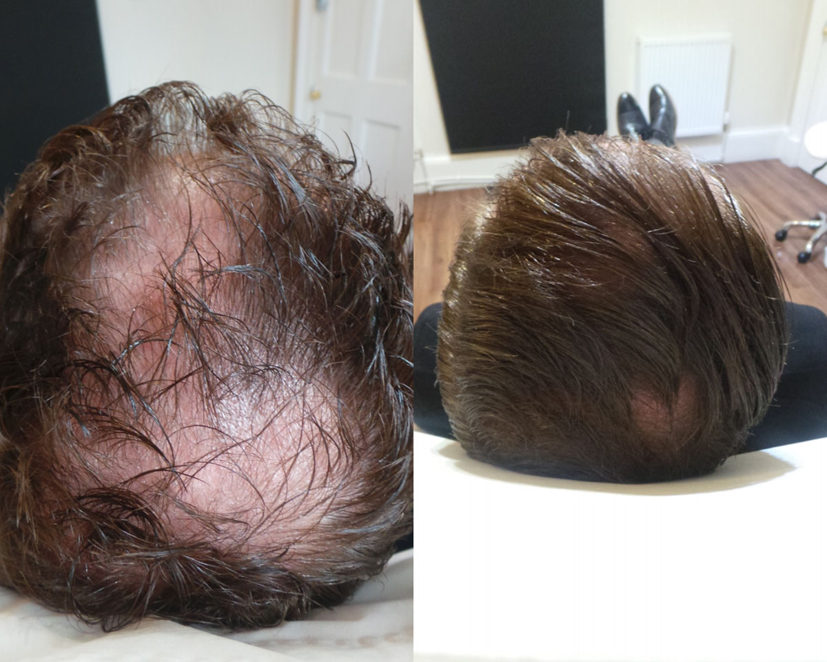 Before and aft photo for hair loss after treatment