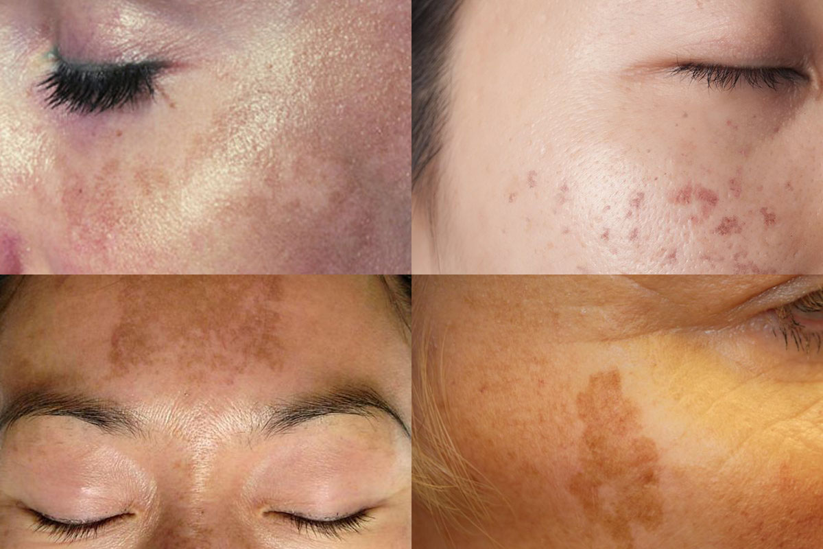 Four types of hyperpigmentation