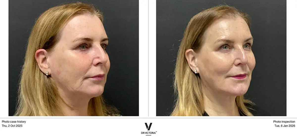 female before and after photos following PRP Bio-volumising injections