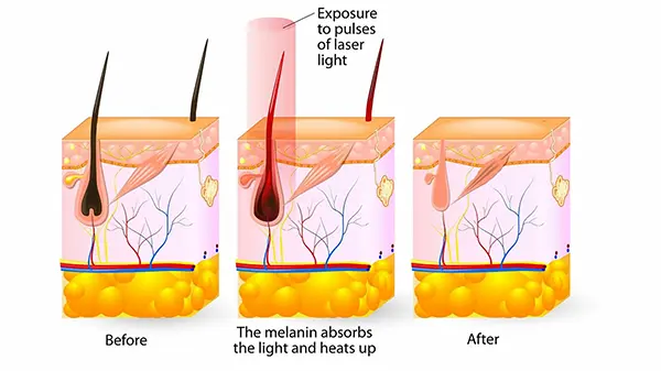 how laser hair removal works