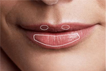 Lip fillers can create lip volume