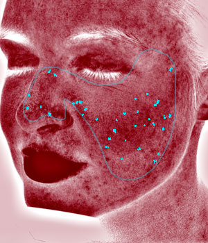 Skin analysis report for red spots