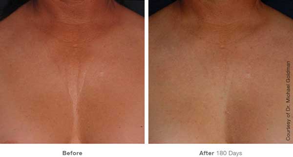 Ultherapy treatment for chest wrinkles - before & after photos.