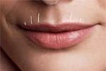 Lip fillers can soften lines on the upper lip