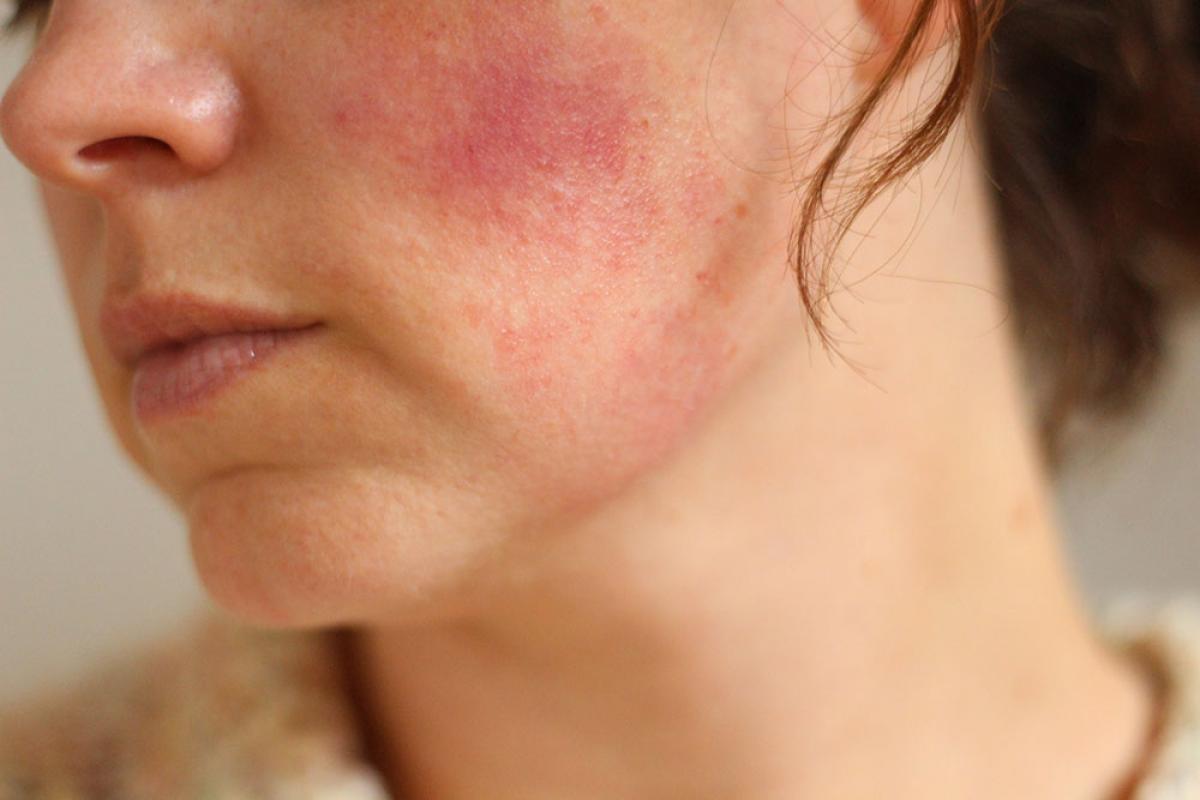 IPL Rosacea & Pigmentation Skin Rejuvenation in Edinburgh