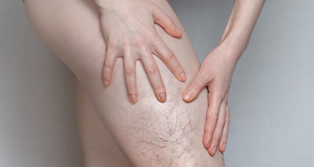 Spider Veins Removal / Treatment And The NHS