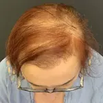 Woman with hair loss to the scalp