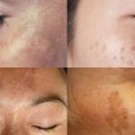 Photo showing 4 types of hyperpigmentation