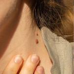 Skin tag on neck