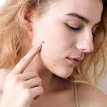 Photo of woman pointing to skin growth on her face