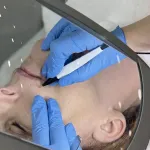 Electrolysis hair removal upper lip