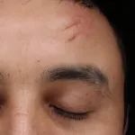 Trauma scar on forehead