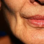 Female face with  volume loss in cheeks