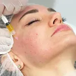 PRP being injected for a facial treatment