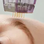 RF microneedling