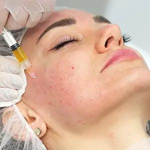 Platelet-Rich Plasma