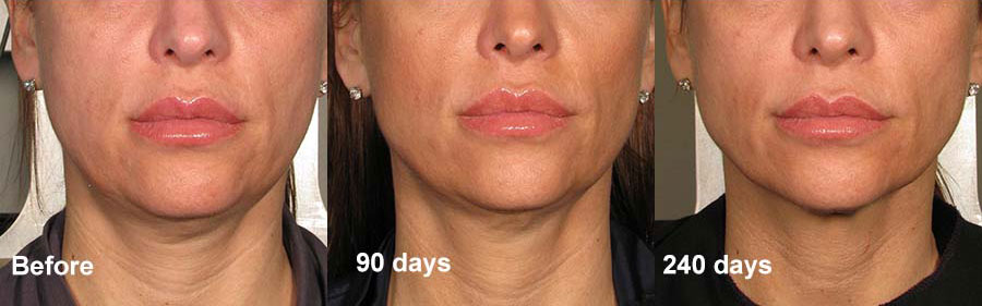 Ultherapy Jowls Before And After