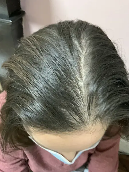 After PRP hair loss treatment