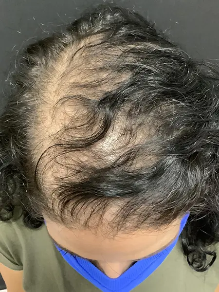 Before PRP hair loss treatment